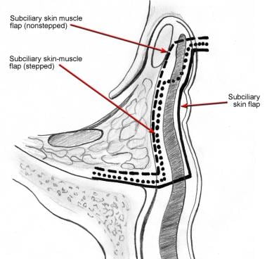 Illustration depicts the subciliary approach to th