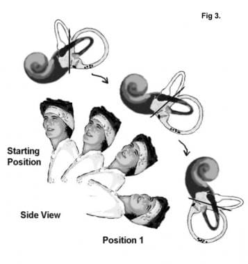 Epley Maneuver for dizziness and vertigo relief