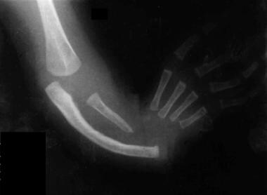 Plain radiograph of the right forearm and hand of 
