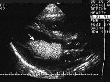 Echocardiographic parasternal long-axis view showi