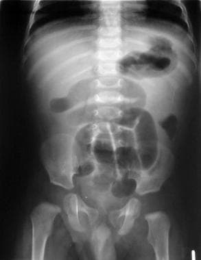 Small-bowel obstruction caused by intussusception 