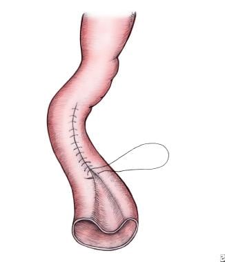 Hernias of the Abdominal Wall - Gastrointestinal Disorders - Merck Manuals  Professional Edition