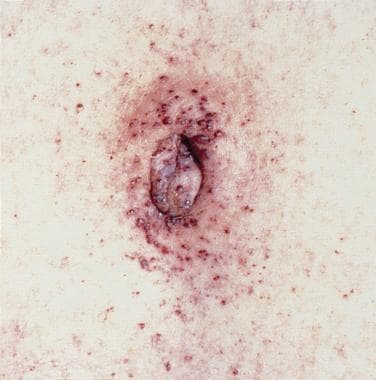 Angiokeratoma is the small punctate reddish-to-blu