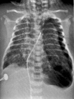 Left pneumothorax with depressed diaphragm and min