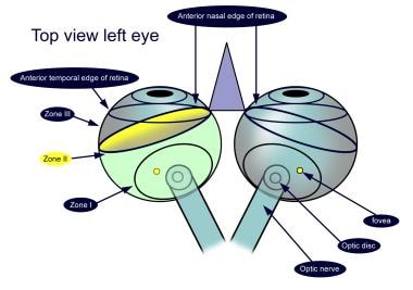 Retinopathy of Prematurity. Zone II retinopathy of