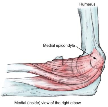 Medial Epicondyle Of Humerus Pain