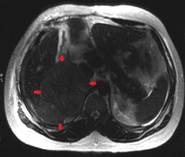 This axial T2W HASTE image demonstrates a large ri