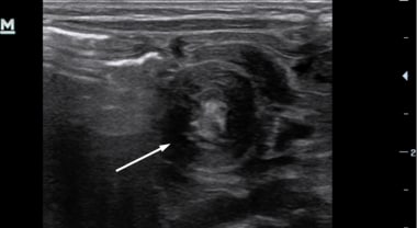 pyloric stenosis shoulder sign