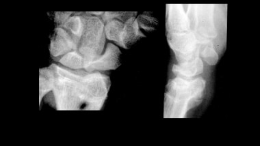 Growth plate (physeal) fractures. Partial correcti