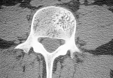 Spinal tumors. Axial CT scan of hemangioma in lumb