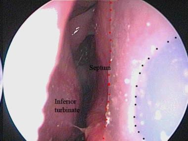 Endoscopic view of a nasal septal button from the 