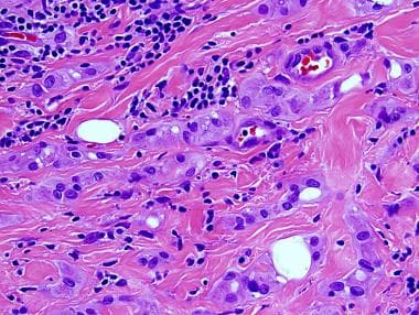 Testicular Adenomatoid Tumor Pathology. Cytologic 