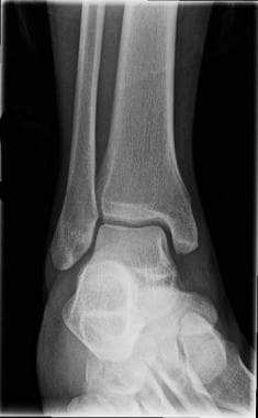 Mortise ankle radiograph. 