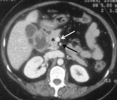 Computed tomography (CT) scan showing the pancreas