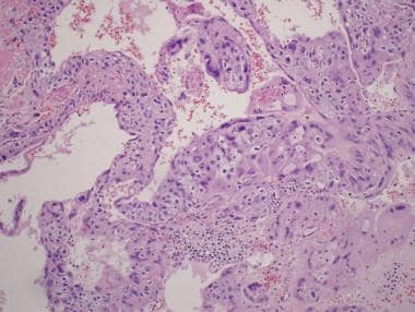 Pathology Of Testicular Choriocarcinoma Overview Etiology - 