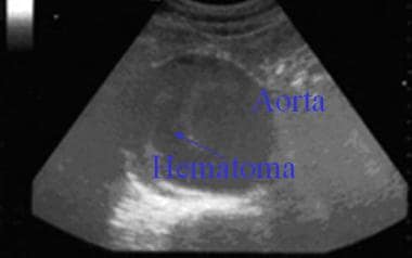 Transverse view of 7-cm abdominal aortic aneurysm.