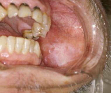 The lesion is an example of leukoplakia. 