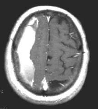 Isodense subdural hematoma (SDH) as pictured with 
