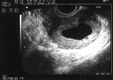 Pregnancy diagnosis. This is a gestational sac (GS