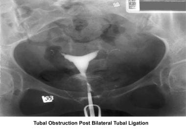 Infertility. Tubal obstruction post–bilateral tuba
