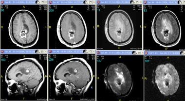 Grade III astrocytoma in a 33-year-old woman. Top 