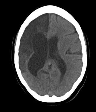 Noncontrast CT of the brain in a patient with hist