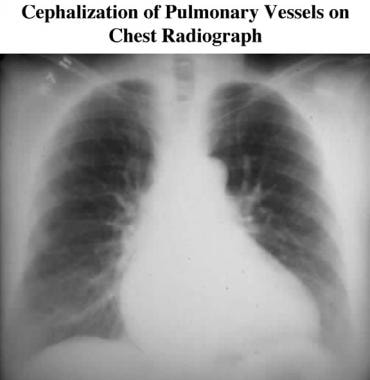 Chest radiograph in a patient with dilated cardiom