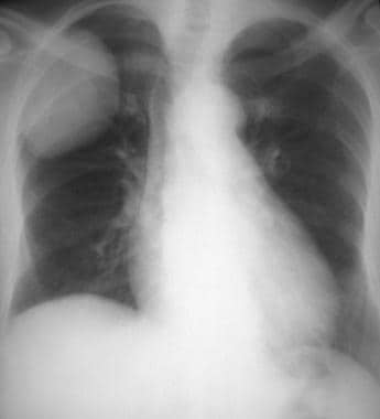 Posteroanterior chest radiograph shows a mass with