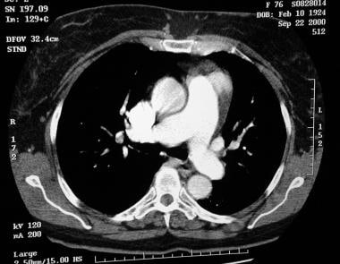 Pulmonary hypertension. Spiral CT scan in a patien
