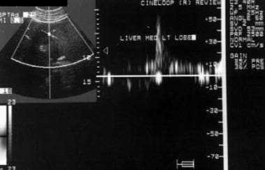Doppler ultrasonogram. A patient with cirrhosis wh
