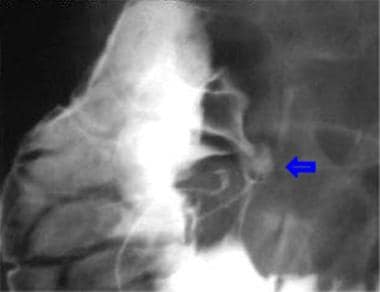 Lateral view of an anterior wall duodenal ulcer in