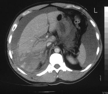 Contrast-enhanced axial CT scan in a 39-year-old m