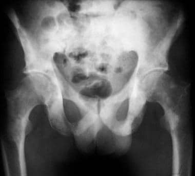 Pelvic radiograph shows widespread, osteoblastic, 