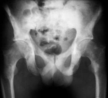 enlarged prostate x ray