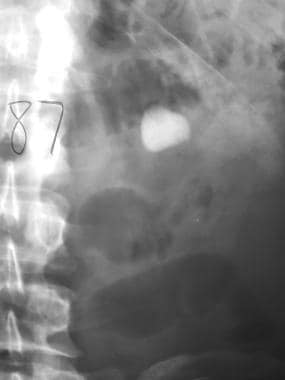 Scout intravenous urogram shows a smooth, dense, r