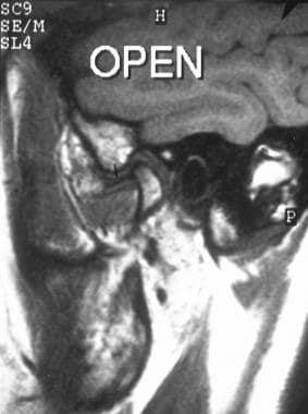 Sagittal T1-weighted MRI image through the left te