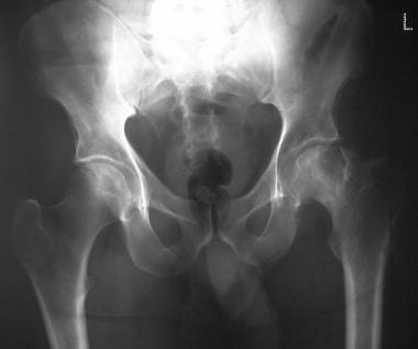 Plain radiograph of the pelvis in a man demonstrat