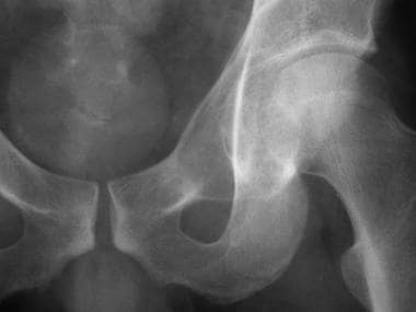Frontal radiograph of the left acetabulum demonstr