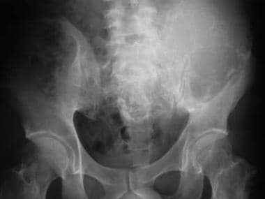 Anteroposterior radiograph of the pelvis shows mul