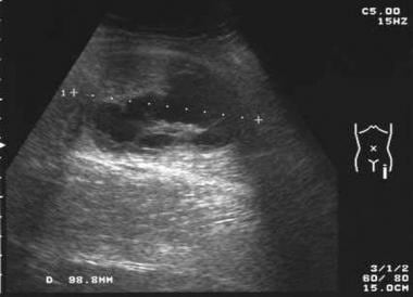 Ultrasound image demonstrates a predominantly hypo