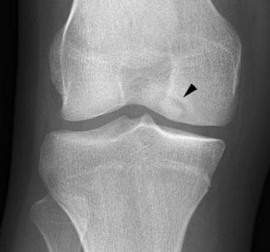 Anteroposterior radiograph of the knee reveals ost