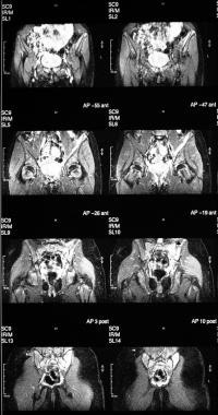 Short-tau inversion recovery (STIR) MRI obtained t
