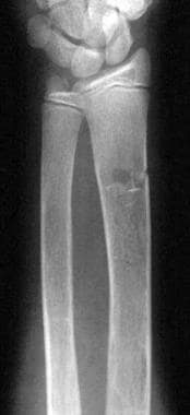 Thalassemia. Anteroposterior radiograph of the for