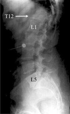Thoracic spine trauma. Lateral radiograph of the l
