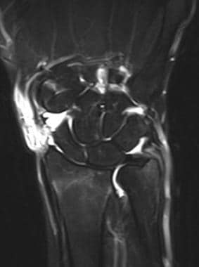 T2-weighted MRI of the wrist in the same patient e