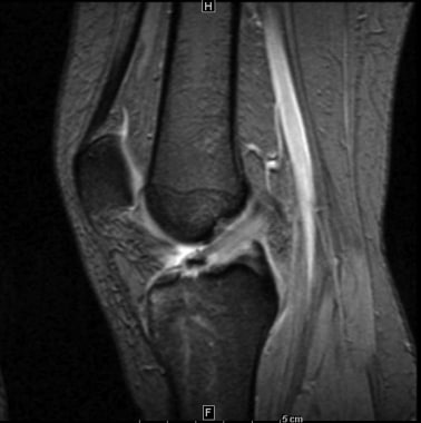 Osseous avulsion of the anterior cruciate ligament