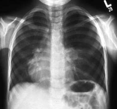 Two-year-old patient with respiratory distress sho