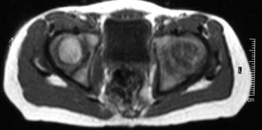 Legg-Calvé-Perthes disease. Axial T1-weighted MRIs