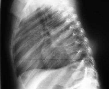 Lateral view of the chest in the same patient as i