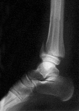 Salter-Harris type II fracture of the distal tibia